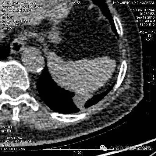 【病例】粘液型肺腺癌3例CT影像表现与分析 【病例】粘液型肺腺癌3例CT影像表现与分析