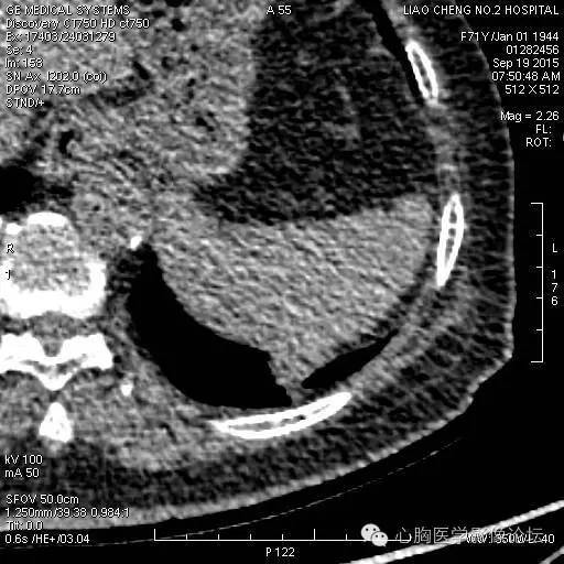 【病例】粘液型肺腺癌3例CT影像表现与分析 【病例】粘液型肺腺癌3例CT影像表现与分析