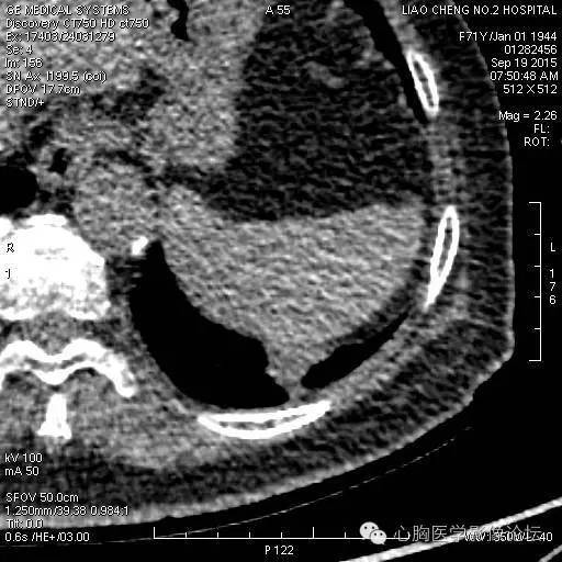 【病例】粘液型肺腺癌3例CT影像表现与分析 【病例】粘液型肺腺癌3例CT影像表现与分析