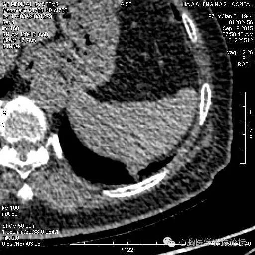 【病例】粘液型肺腺癌3例CT影像表现与分析 【病例】粘液型肺腺癌3例CT影像表现与分析