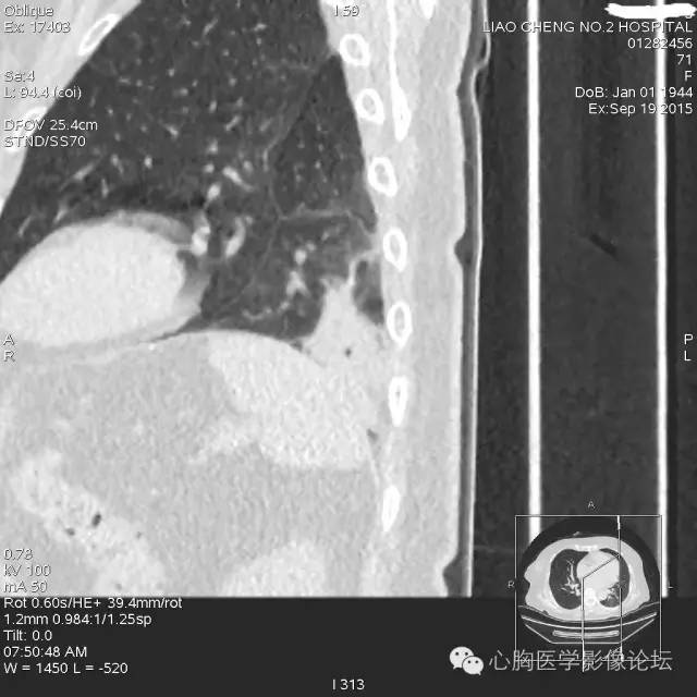 【病例】粘液型肺腺癌3例CT影像表现与分析 【病例】粘液型肺腺癌3例CT影像表现与分析