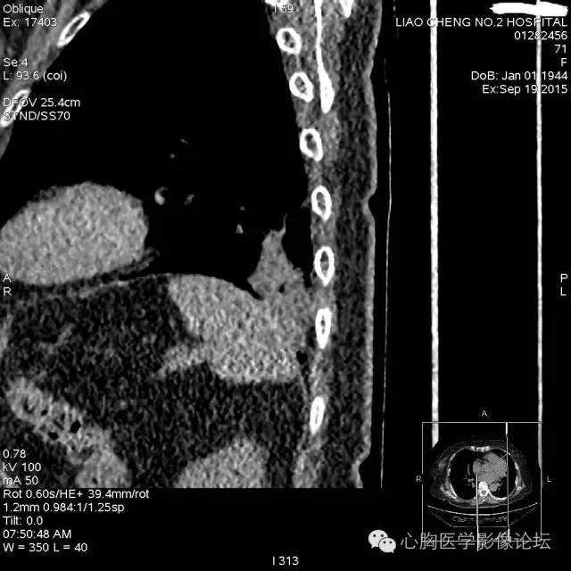 【病例】粘液型肺腺癌3例CT影像表现与分析 【病例】粘液型肺腺癌3例CT影像表现与分析