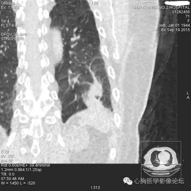 【病例】粘液型肺腺癌3例CT影像表现与分析 【病例】粘液型肺腺癌3例CT影像表现与分析