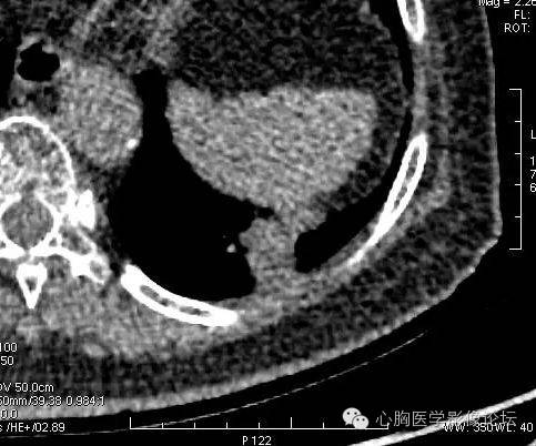 【病例】粘液型肺腺癌3例CT影像表现与分析 【病例】粘液型肺腺癌3例CT影像表现与分析