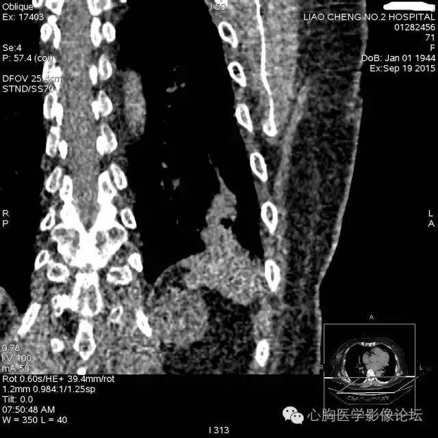 【病例】粘液型肺腺癌3例CT影像表现与分析 【病例】粘液型肺腺癌3例CT影像表现与分析