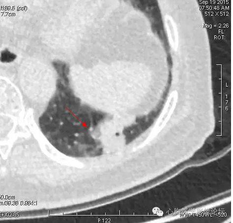 【病例】粘液型肺腺癌3例CT影像表现与分析 【病例】粘液型肺腺癌3例CT影像表现与分析