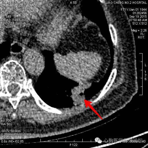 【病例】粘液型肺腺癌3例CT影像表现与分析 【病例】粘液型肺腺癌3例CT影像表现与分析