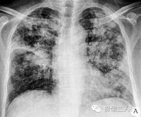 【病例】浸润型肺结核？肺泡癌