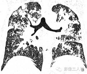 【病例】浸润型肺结核？肺泡癌