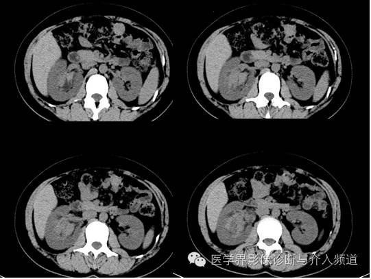 【病例】肾血管平滑肌脂肪瘤1例CT影像表现 【病例】肾血管平滑肌脂肪瘤1例CT影像表现