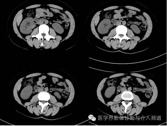 【病例】肾血管平滑肌脂肪瘤1例CT影像表现 【病例】肾血管平滑肌脂肪瘤1例CT影像表现