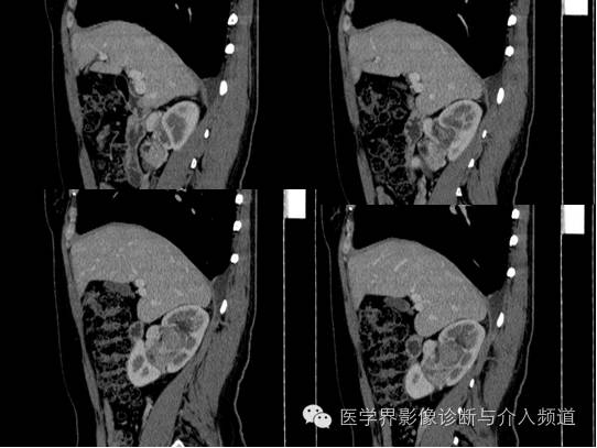 【病例】肾血管平滑肌脂肪瘤1例CT影像表现 【病例】肾血管平滑肌脂肪瘤1例CT影像表现