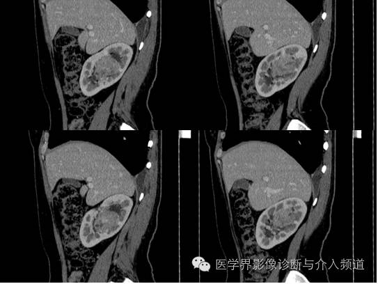 【病例】肾血管平滑肌脂肪瘤1例CT影像表现 【病例】肾血管平滑肌脂肪瘤1例CT影像表现