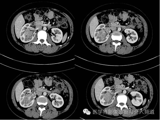 【病例】肾血管平滑肌脂肪瘤1例CT影像表现 【病例】肾血管平滑肌脂肪瘤1例CT影像表现