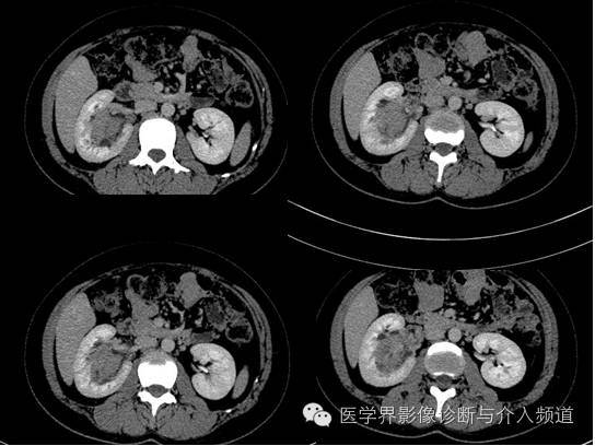 【病例】肾血管平滑肌脂肪瘤1例CT影像表现