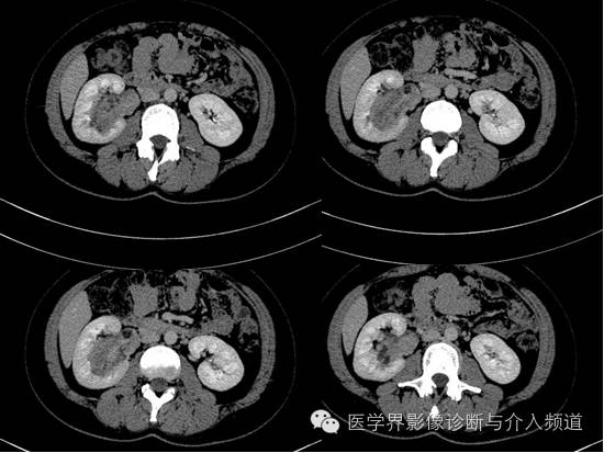 【病例】肾血管平滑肌脂肪瘤1例CT影像表现 【病例】肾血管平滑肌脂肪瘤1例CT影像表现