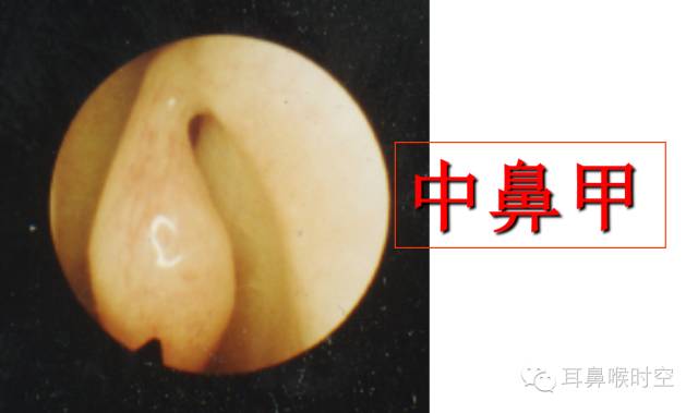 经常看鼻窦,您知道鼻窦的哪些变异与鼻窦炎和手术有关系吗? 经常看鼻窦,您知道鼻窦的哪些变异与鼻窦炎和手术有关系吗?