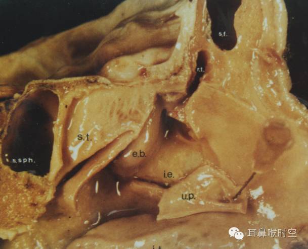 经常看鼻窦,您知道鼻窦的哪些变异与鼻窦炎和手术有关系吗? 经常看鼻窦,您知道鼻窦的哪些变异与鼻窦炎和手术有关系吗?