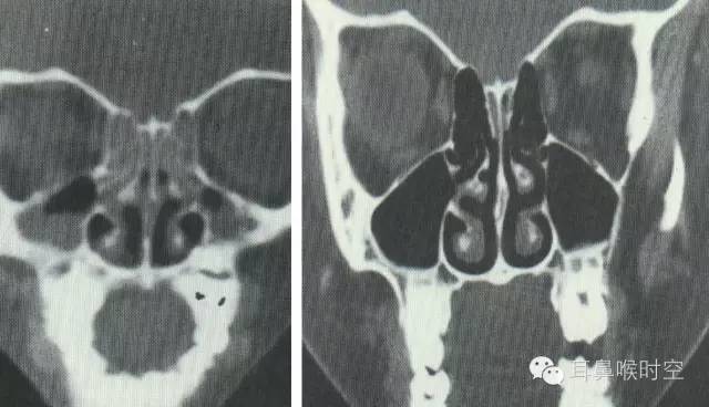 经常看鼻窦,您知道鼻窦的哪些变异与鼻窦炎和手术有关系吗? 经常看鼻窦,您知道鼻窦的哪些变异与鼻窦炎和手术有关系吗?