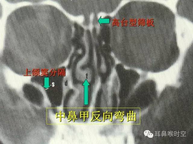 经常看鼻窦，您知道鼻窦的哪些变异与鼻窦炎和手术有关系吗？