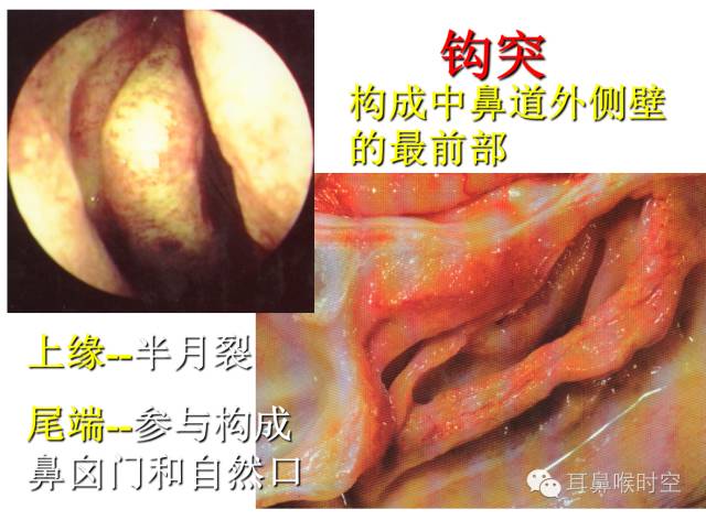 经常看鼻窦,您知道鼻窦的哪些变异与鼻窦炎和手术有关系吗? 经常看鼻窦,您知道鼻窦的哪些变异与鼻窦炎和手术有关系吗?