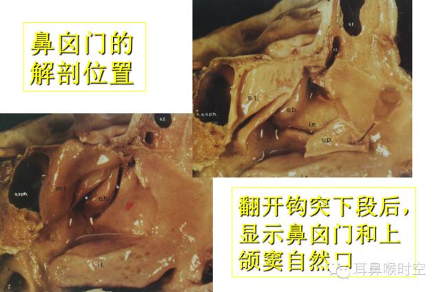 经常看鼻窦,您知道鼻窦的哪些变异与鼻窦炎和手术有关系吗? 经常看鼻窦,您知道鼻窦的哪些变异与鼻窦炎和手术有关系吗?