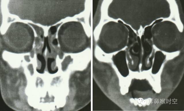 经常看鼻窦,您知道鼻窦的哪些变异与鼻窦炎和手术有关系吗? 经常看鼻窦,您知道鼻窦的哪些变异与鼻窦炎和手术有关系吗?