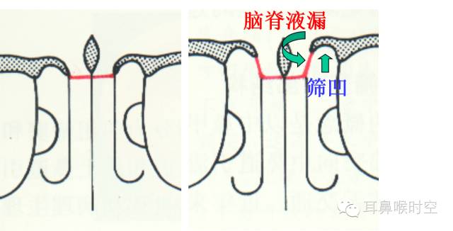 经常看鼻窦,您知道鼻窦的哪些变异与鼻窦炎和手术有关系吗? 经常看鼻窦,您知道鼻窦的哪些变异与鼻窦炎和手术有关系吗?
