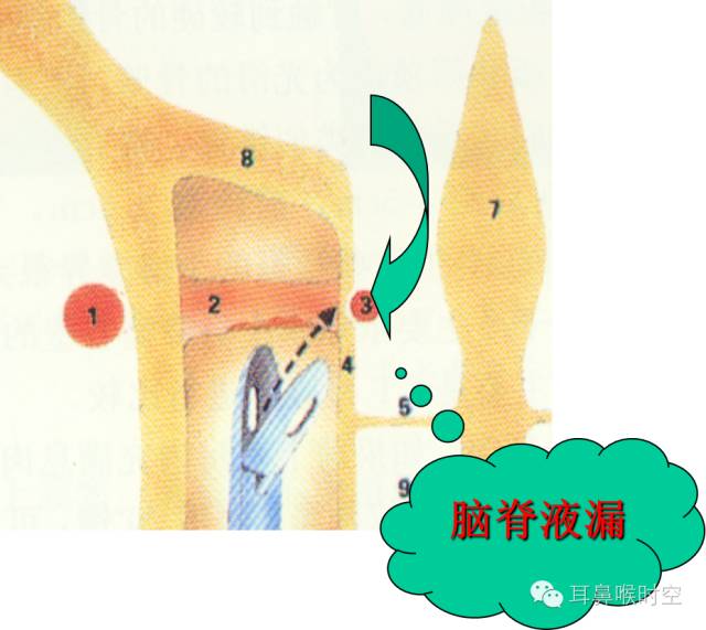 经常看鼻窦,您知道鼻窦的哪些变异与鼻窦炎和手术有关系吗? 经常看鼻窦,您知道鼻窦的哪些变异与鼻窦炎和手术有关系吗?