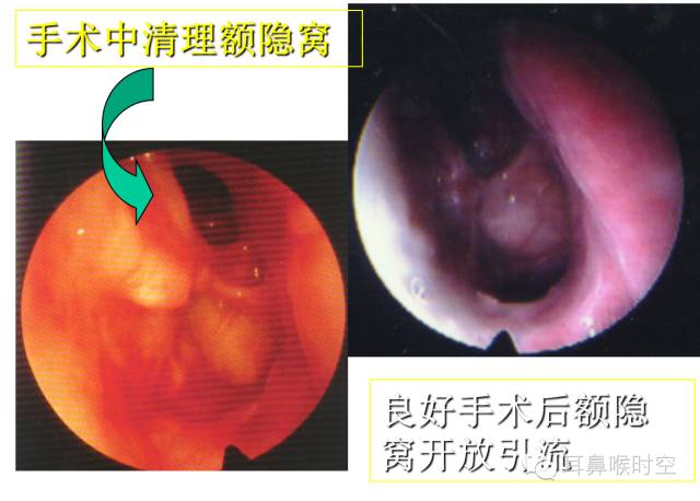 经常看鼻窦,您知道鼻窦的哪些变异与鼻窦炎和手术有关系吗? 经常看鼻窦,您知道鼻窦的哪些变异与鼻窦炎和手术有关系吗?