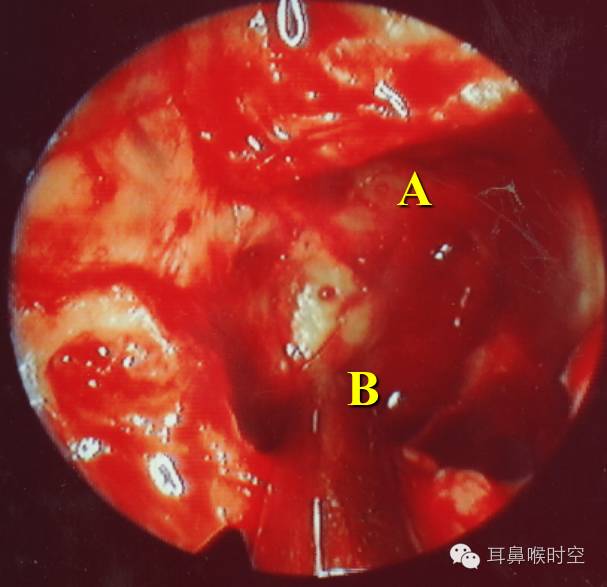 经常看鼻窦,您知道鼻窦的哪些变异与鼻窦炎和手术有关系吗? 经常看鼻窦,您知道鼻窦的哪些变异与鼻窦炎和手术有关系吗?