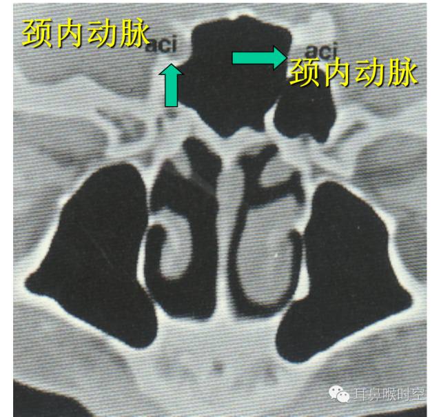 经常看鼻窦,您知道鼻窦的哪些变异与鼻窦炎和手术有关系吗? 经常看鼻窦,您知道鼻窦的哪些变异与鼻窦炎和手术有关系吗?