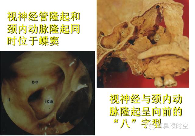经常看鼻窦,您知道鼻窦的哪些变异与鼻窦炎和手术有关系吗? 经常看鼻窦,您知道鼻窦的哪些变异与鼻窦炎和手术有关系吗?