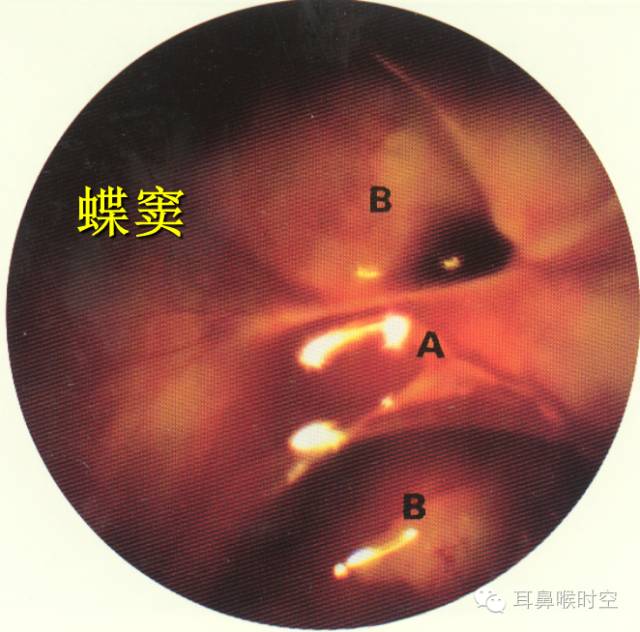 经常看鼻窦,您知道鼻窦的哪些变异与鼻窦炎和手术有关系吗? 经常看鼻窦,您知道鼻窦的哪些变异与鼻窦炎和手术有关系吗?