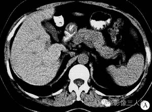 【病例】胰腺体部胰岛细胞瘤1例CT及MR影像表现