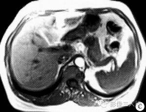 【病例】胰腺体部胰岛细胞瘤1例CT及MR影像表现 【病例】胰腺体部胰岛细胞瘤1例CT及MR影像表现
