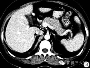 【病例】胰腺体部胰岛细胞瘤1例CT及MR影像表现 【病例】胰腺体部胰岛细胞瘤1例CT及MR影像表现