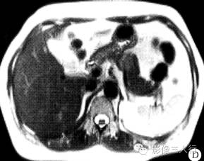 【病例】胰腺体部胰岛细胞瘤1例CT及MR影像表现 【病例】胰腺体部胰岛细胞瘤1例CT及MR影像表现