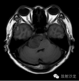 【病例】斜坡脊索瘤1例MR影像表现