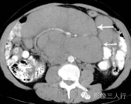 "三明治征"，这个征象提示啥？