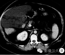【病例】腹腔淋巴管瘤1例CT影像表现