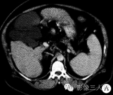 【病例】腹腔淋巴管瘤1例CT影像表现 【病例】腹腔淋巴管瘤1例CT影像表现