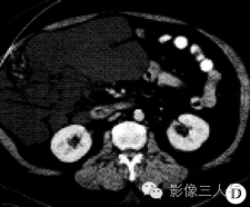 【病例】腹腔淋巴管瘤1例CT影像表现 【病例】腹腔淋巴管瘤1例CT影像表现
