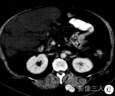【病例】腹腔淋巴管瘤1例CT影像表现 【病例】腹腔淋巴管瘤1例CT影像表现