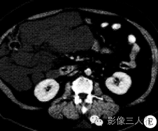 【病例】腹腔淋巴管瘤1例CT影像表现 【病例】腹腔淋巴管瘤1例CT影像表现