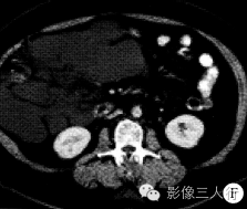 【病例】腹腔淋巴管瘤1例CT影像表现 【病例】腹腔淋巴管瘤1例CT影像表现
