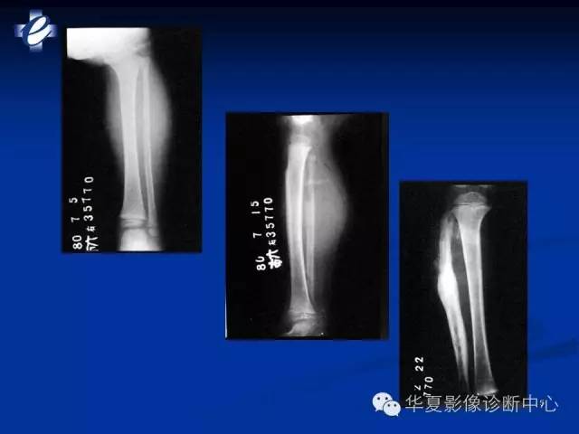 【PPT】骨与关节感染的影像学诊断