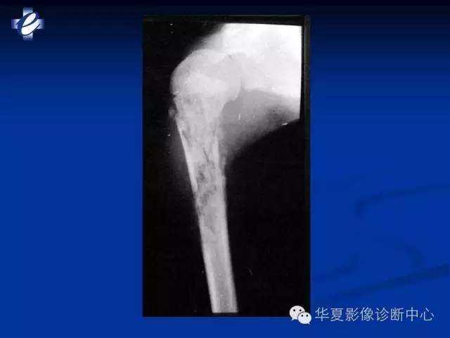 【PPT】骨与关节感染的影像学诊断
