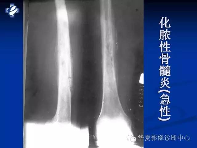 【PPT】骨与关节感染的影像学诊断