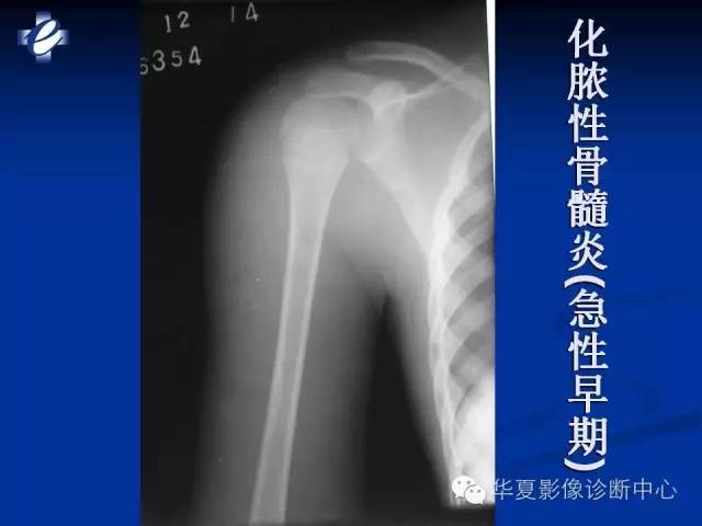 【PPT】骨与关节感染的影像学诊断